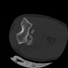 SPORK, NICO - 22.03.1976 - 02.08.2022 - CT obere Extremität - 17:51:17